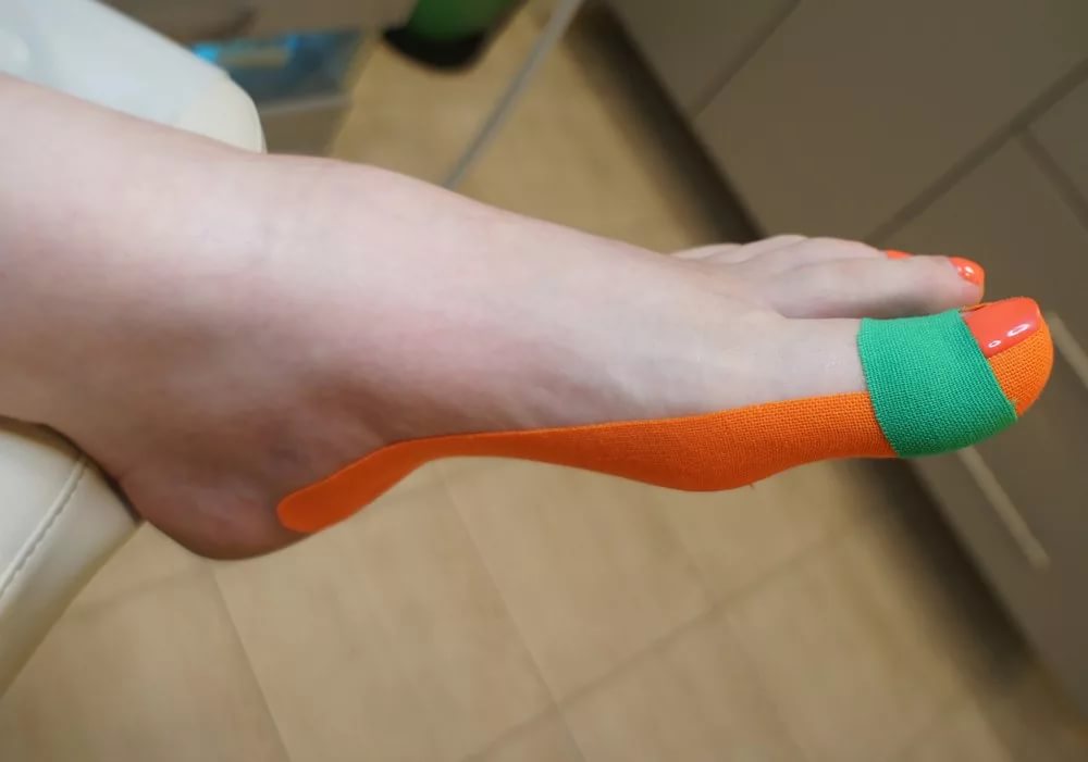 Как затейпировать большой палец на ноге