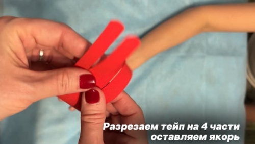 Тейпирование при растяжении кисти