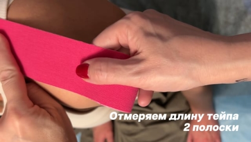 Тейпирование при растяжении плеча